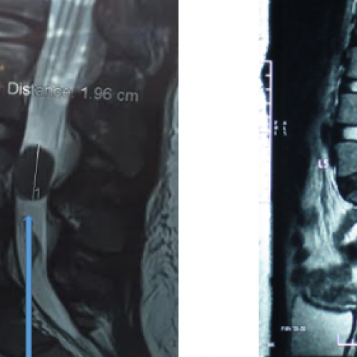 腳痛！當心椎管內脊膜瘤