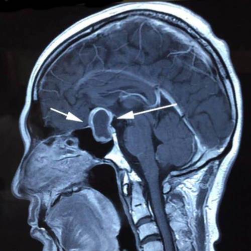 認識腦下垂體腫瘤