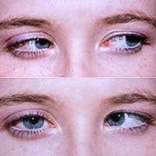 左椎动脉脑动脉瘤