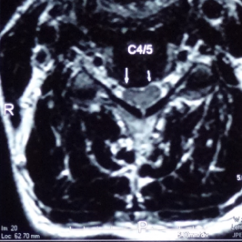 頸椎椎間盤突出症狀誤似中風