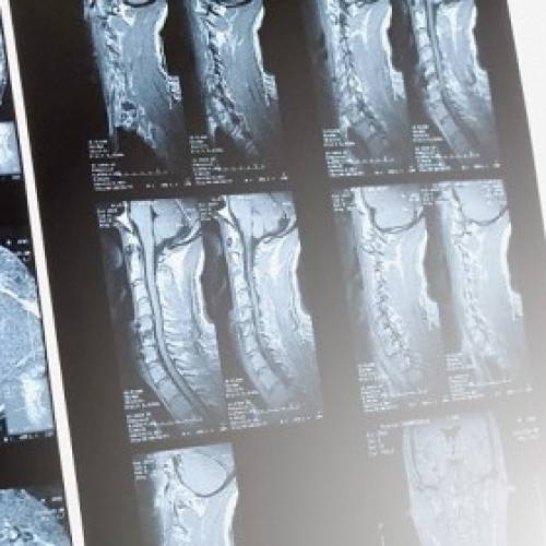 「椎間盤突出」和「椎間盤脫出或溢出」的分別