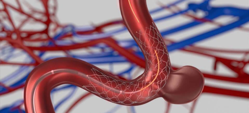 微細的管導支架（Pipeline Stent）