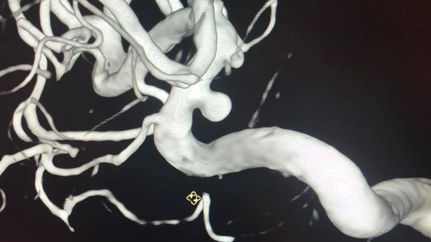 磁力共振（MRI）顯示的腦血管動脈瘤